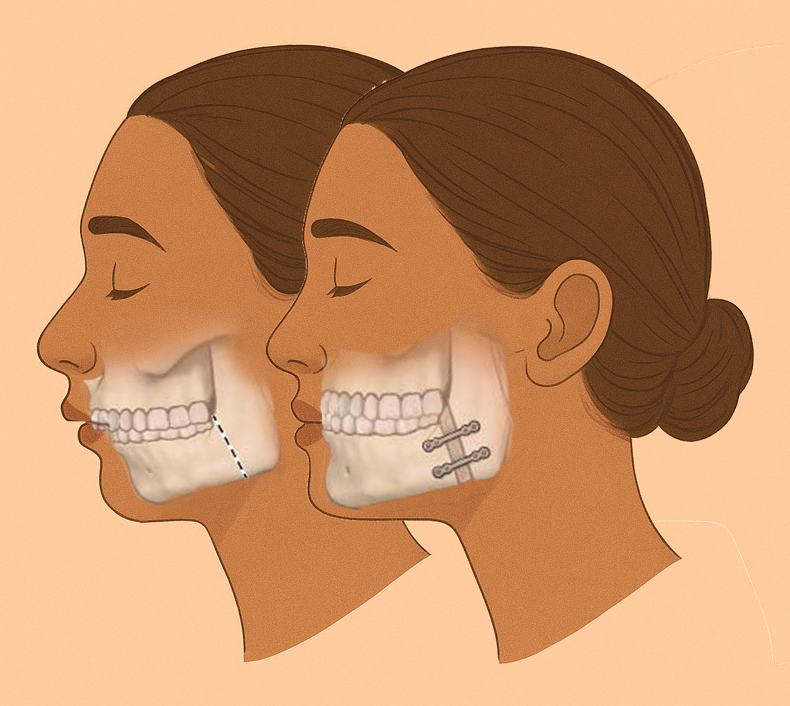 Orthognathic Surgery